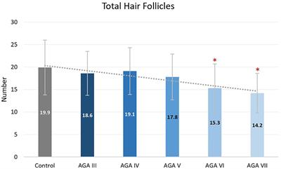 Histopathological Evidence of Occipital Involvement in Male Androgenetic Alopecia